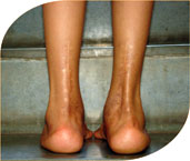 surgery of both his feet one by one and then given corrective plasters and then special splints to maintain correction