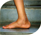 surgery of both his feet one by one and then given corrective plasters and then special splints to maintain correction