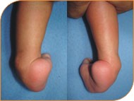 Club Foot Symptoms