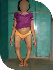 Chandani, a chirpy 12 year old girl with gross bowing of legs. She could not walk long and could not play with her friends. 