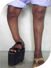 She then underwent surgery on her right leg with Ilizarov technique. During this surgery her deformity was completely corrected and she gained extra length of10 cm.
