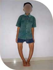 bow legs due to Rickets (vit D deficiency)