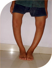 bow legs due to Rickets (vit D deficiency)