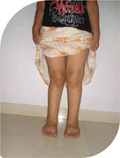 She underwent screw hemi epiphysiodesis correcting deformity in two years. 