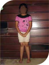 She underwent plate hemi epiphysiodesis before six months. In these six months the distance between her two ankles has reduced from 27 centimeters to 14 centimeters. After full correction of the deformity the plate would be removed to allow normal growth to take place.