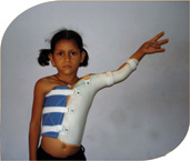 Erb's Palsy (OBPP), Patient (1) Himani Patel, Post-Operation