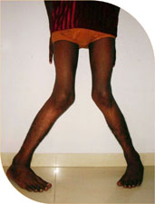 Himatsinh 16 yr old boy from Rajasthan with gross knock knees