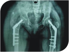 A special x ray done for her legs showed that she had problem in her hip region and the leg bones were curving inside at two levels.