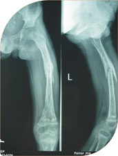 Post infection nonunion of femur (thigh bone)