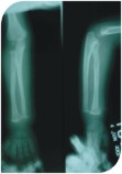 undiagnosed infection of his Radius bone