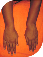 Bhagyashri 15 year old girl with a rare cosmetically disfiguring deformity